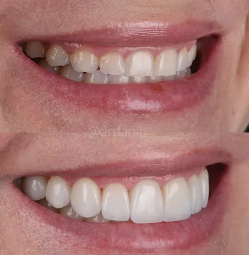 smile correction