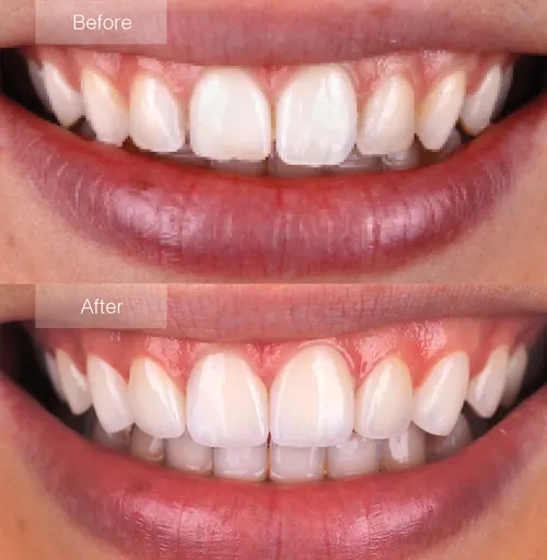 smile makeover