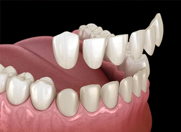 Dental Veneers