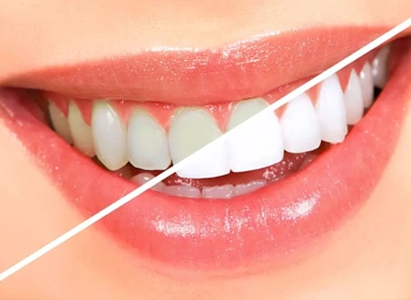 Teeth Whitening