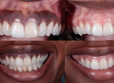 Gum Depigmentation