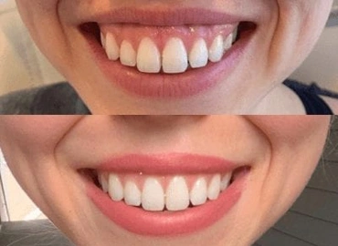 Gummy Smile Treatment