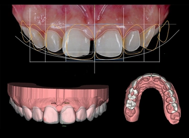 3D Smile Designing