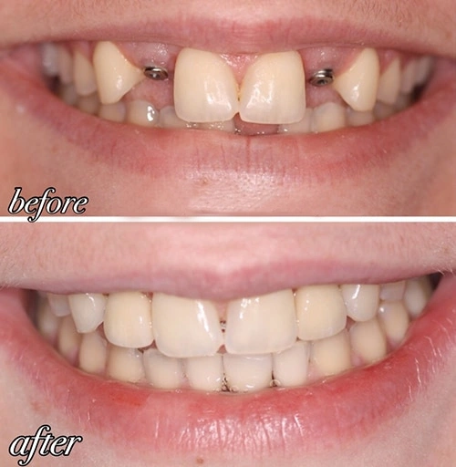 dental implant dentist