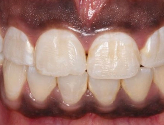 Laser gum depigmentation cost in delhi