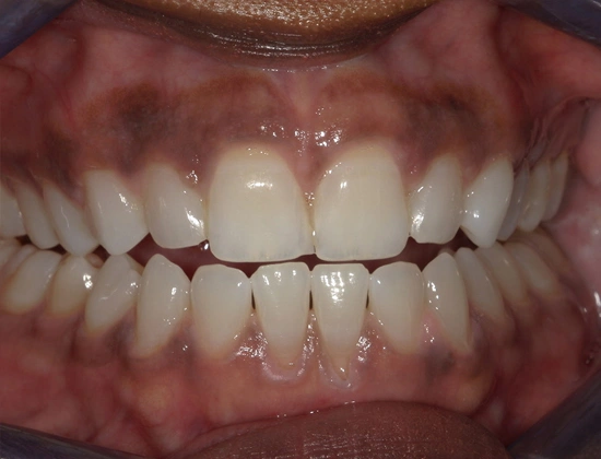 laser gum depigmentation treatment delhi