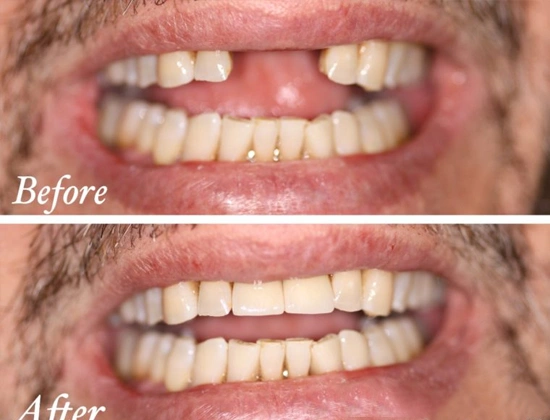 Best Dental Implantologist in Delhi