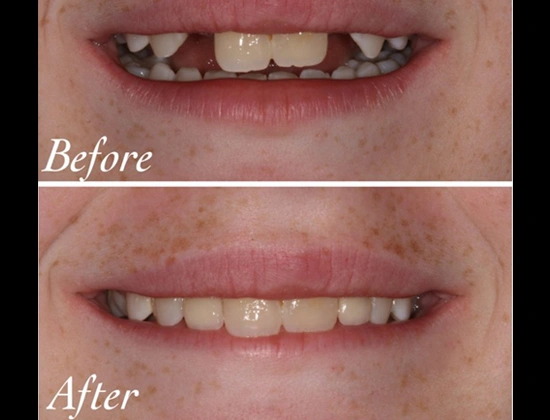Dental Implant Clinic in East Delhi