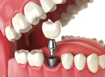Single Dental Implant
