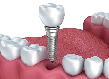 Single Dental Implant + Crown