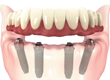 All-on-4 Dental Implants