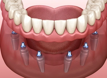 All-on-6 Dental Implants