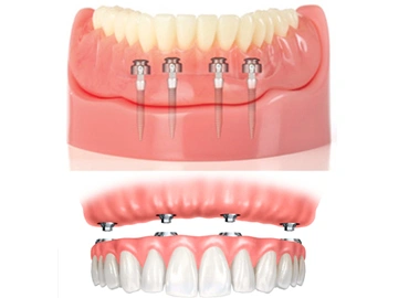Mini Implants
