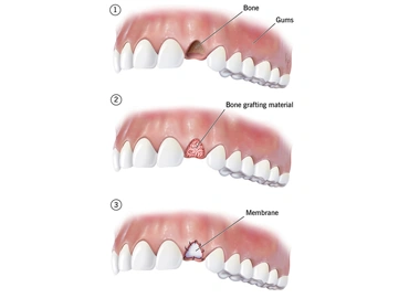 Bone Grafting