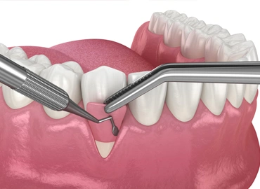 Soft Tissue Grafting