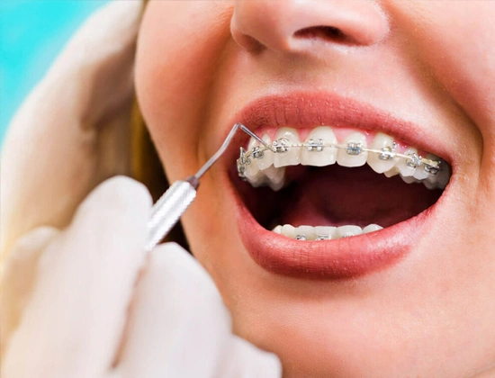 Teeth Braces Cost Delhi