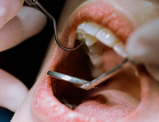 Root Canal Treatment Cost in Delhi