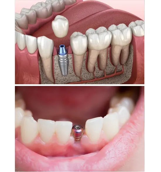 Single Tooth Implant Cost in Delhi