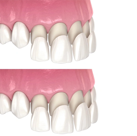 Dental veneers benefits