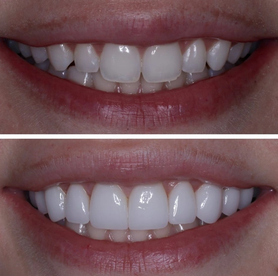 types of veneers?
